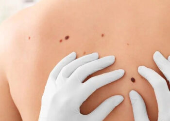 melanoma