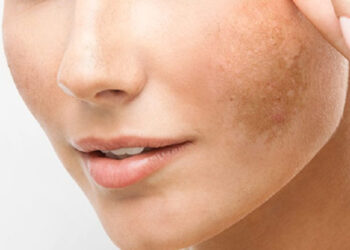 melasma