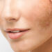 melasma