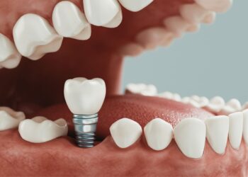 implantes dentales