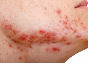 ¿Cómo combatir el acné hormonal en hombres y mujeres?