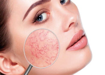 Tips para evitar el enrojecimiento facial que debes conocer