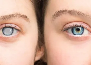 Cataratas oculares: hábitos saludables para conservar la visión