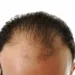 Cómo elegir la mejor clínica capilar en Madrid para tratar la alopecia