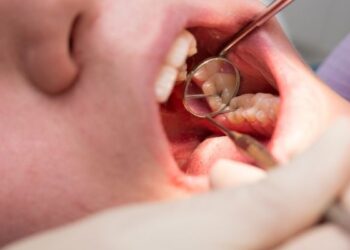Caries en niños: mitos, verdades y cómo prevenirlas